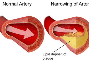 Occlusione delle arterie [foto: Wikimedia Commons, Blausen.com staff courtesy of Oregon State University]